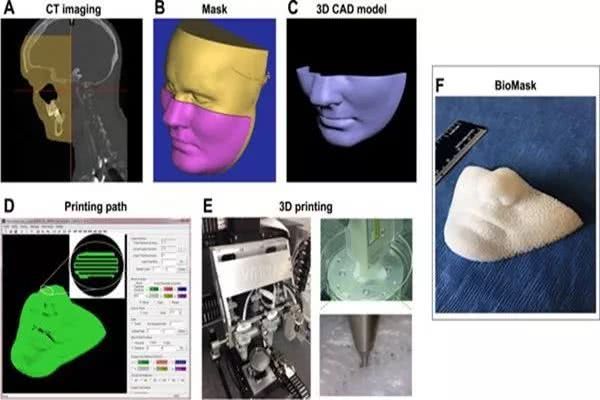 生物3D打印面罩BioMask将有效治疗患者面部创伤